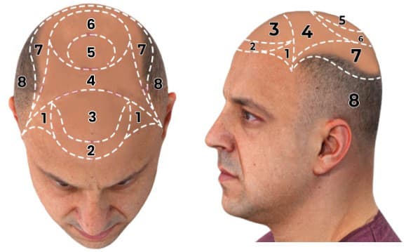 Top and side views showing numbered scalp zones from 1 to 8